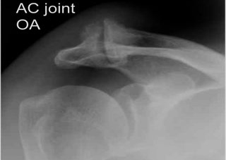 AC Joint Arthritis