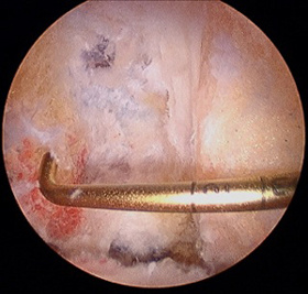 Rotator Cuff Tears: Large