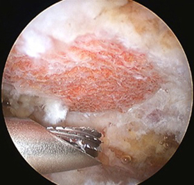Rotator Cuff Tears: Large