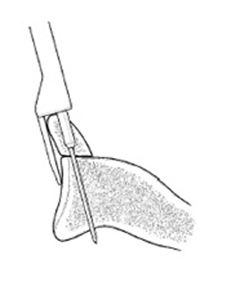 Bone Deficient Anterior Instability