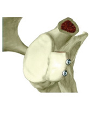 Bone Deficient Anterior Instability