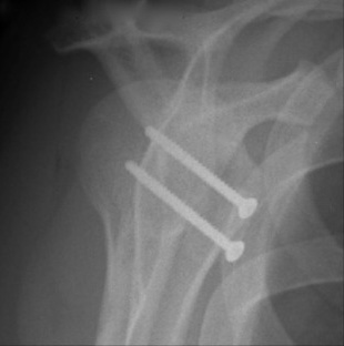 Bone Deficient Anterior Instability