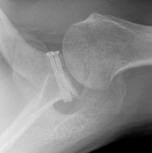 Bone Deficient Anterior Instability