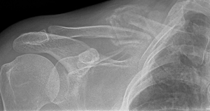Displaced fractures can also be treated non-operatively