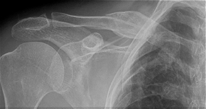 Displaced fractures can also be treated non-operatively