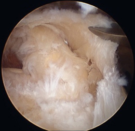 Rotator Cuff Tears: Large