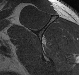 Rotator Cuff Tears: Large