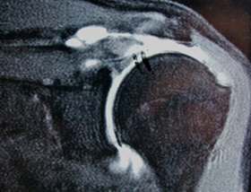 Rotator Cuff Tears: Large