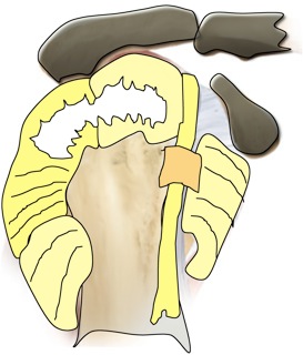 Rotator Cuff Tears: Large