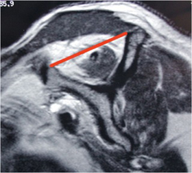 Rotator Cuff Tears: Large