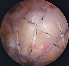 Rotator Cuff Tears: Large