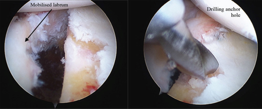 Shoulder Dislocations