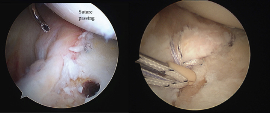 Shoulder Dislocations