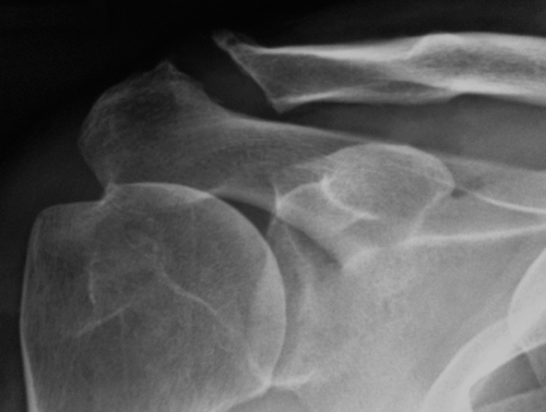 AC Joint Arthritis