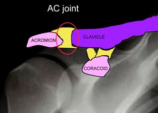 AC Joint Arthritis