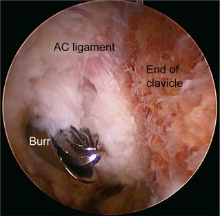 AC Joint Arthritis