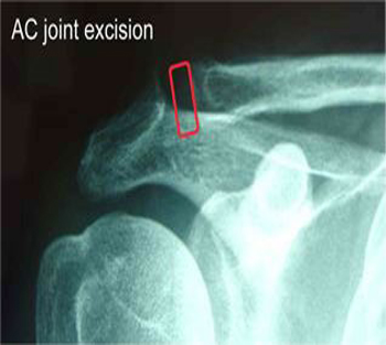 AC Joint Arthritis