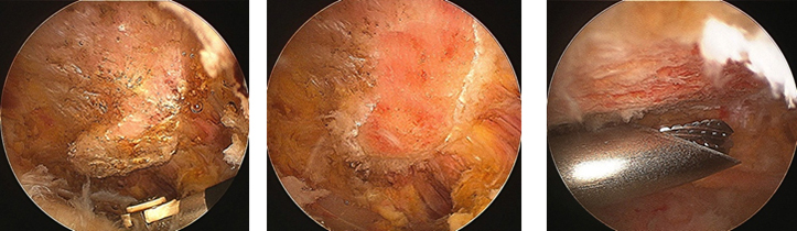 Acromial Spur