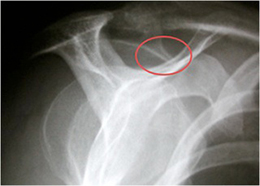 Shoulder Impingement