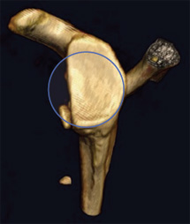 Bone Deficient Anterior Instability