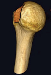 Bone Deficient Anterior Instability
