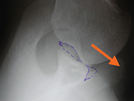 Bone Deficient Anterior Instability