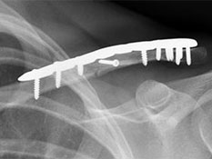 Broken Collarbone