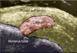 Calcific Tendinitis