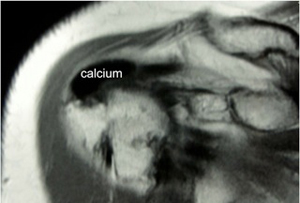 Calcific Tendinitis