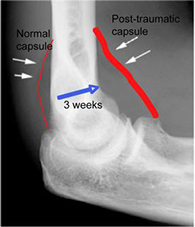 Radial Head Fractures