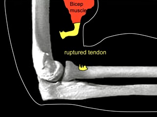 Rotator Cuff Repair, NSW Australia