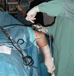 Elbow Arthroscopy