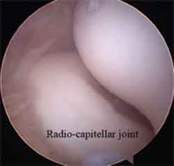 Elbow Arthroscopy