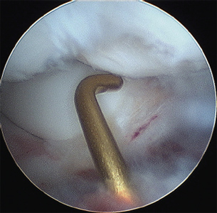 Elbow Arthroscopy