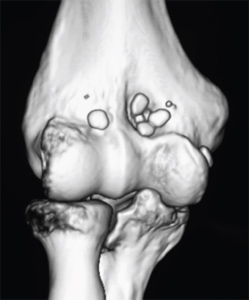 Elbow Arthroscopy