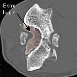 Elbow Arthroscopy