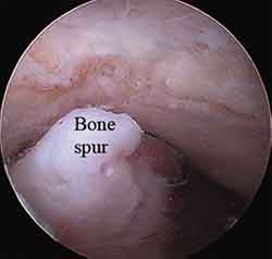 Elbow Arthroscopy