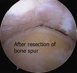 Elbow Arthroscopy