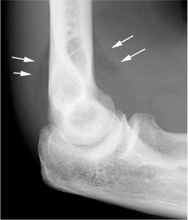 Radial Head Fractures