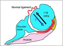 Frozen Shoulder