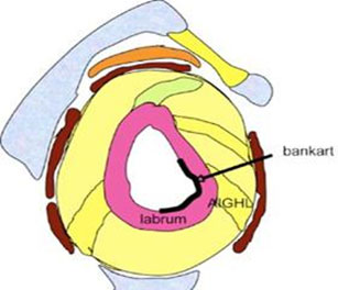 Glenoid Labrum Tear