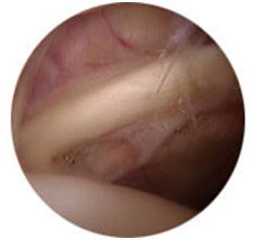 Normal joint lining (capsule)