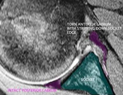 Bone Deficient Anterior Instability