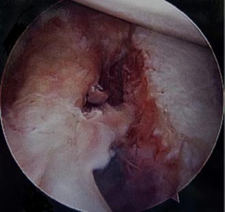 Bone Deficient Anterior Instability