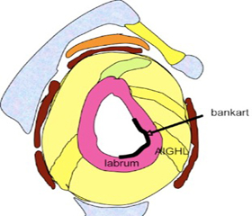 Bankart Tear and Repair