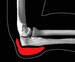 AC Joint Arthritis