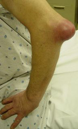 AC Joint Arthritis