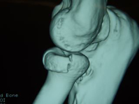 Radial Head Fractures