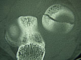 Radial Head Fractures