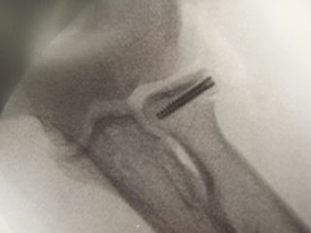 Radial Head Fractures